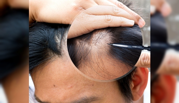 Tabipler Birliği: Çalışma izni olmadan saç ekimi yapanlar tespit edildi!